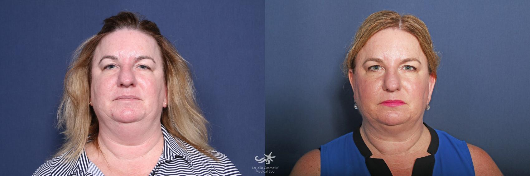 Before & After CoolSculpting® Result 538 Front View in San Diego, Carlsbad, CA