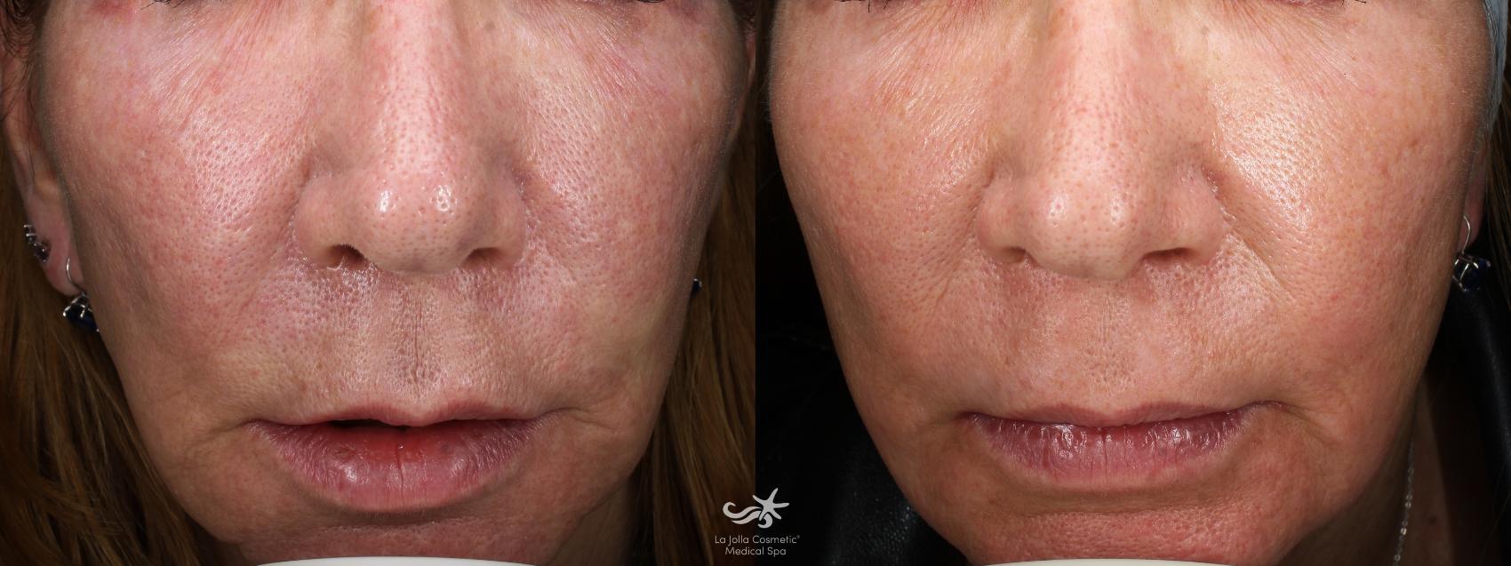 Before & After Laser Treatments Result 673 Front View in San Diego, Carlsbad, CA